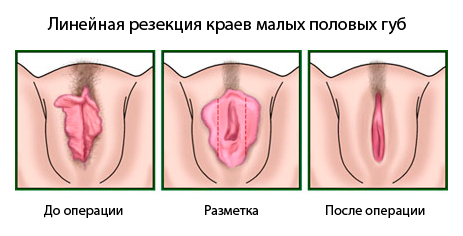 линейная резекция малых половых губ