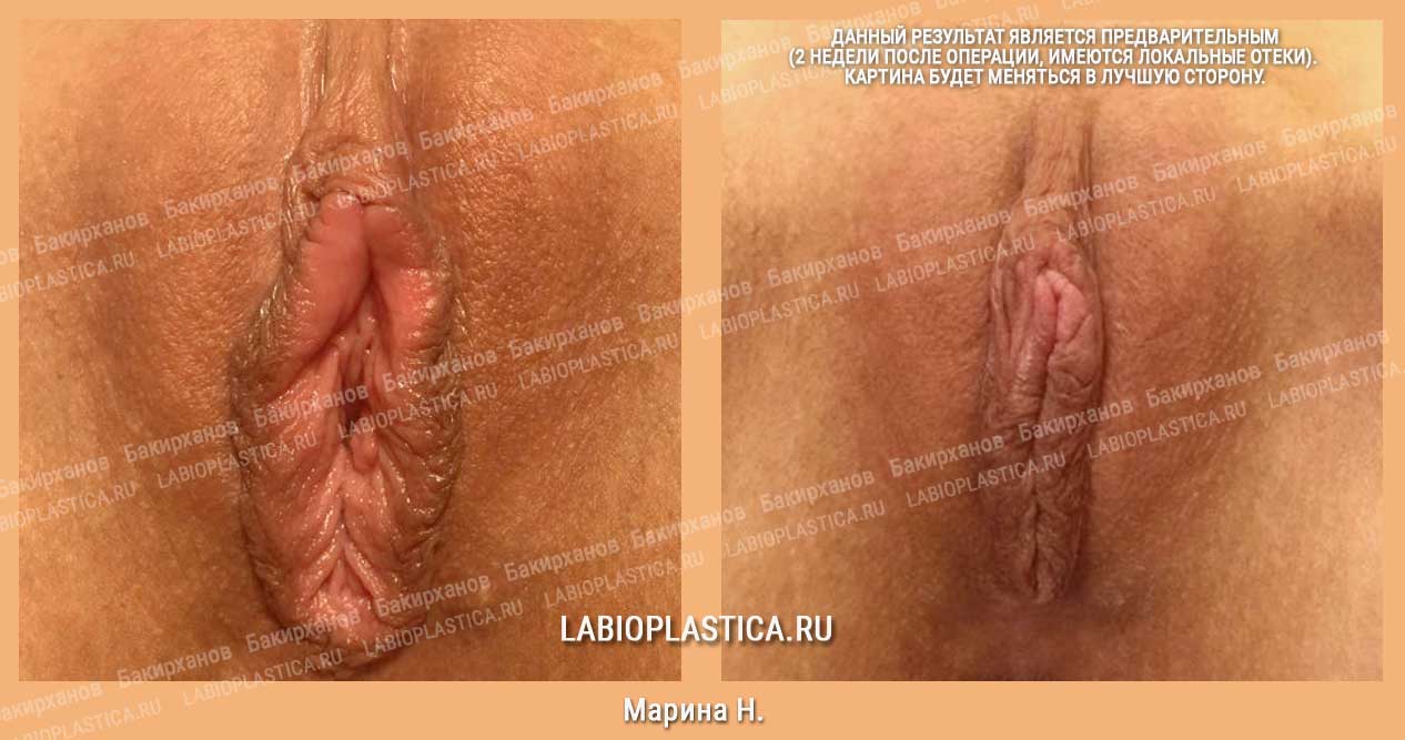 Лабиопластика: фото «до / после»
