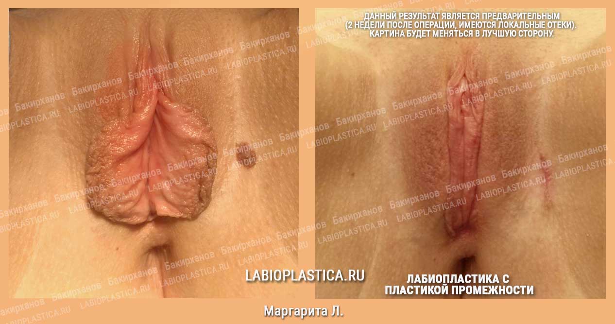 Лабиопластика: фото «до / после»